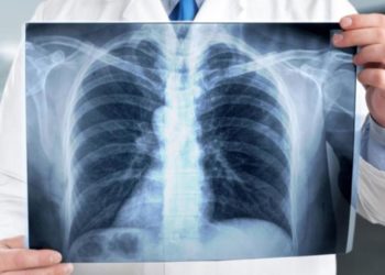 إطلاق الحملة الوطنية للكشف عن داء السل