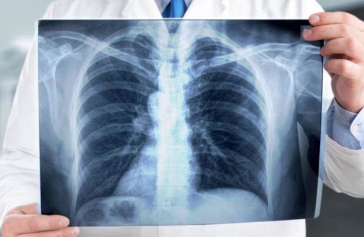 إطلاق الحملة الوطنية للكشف عن داء السل