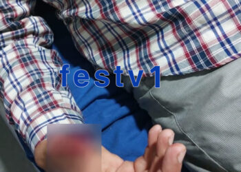 فاس..عضة قوية من مستشار جماعي تتسبب في ضرر كبير في إبهام موظف بمقاطعة زواغة